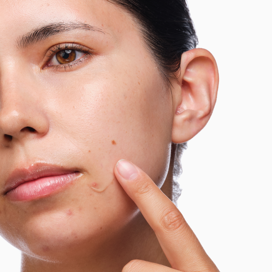 3-Step Acne Set with Salicylic Acid 2% Solution