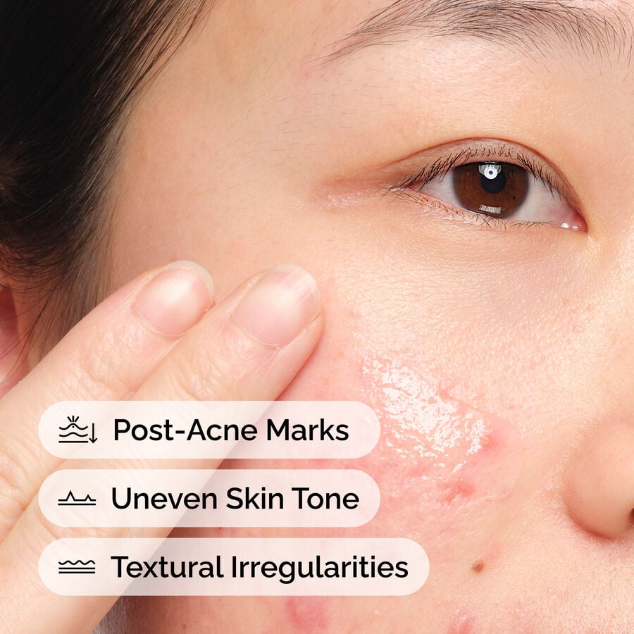 Soothing Aloe 2% and NAG 2% Post-Acne Solution