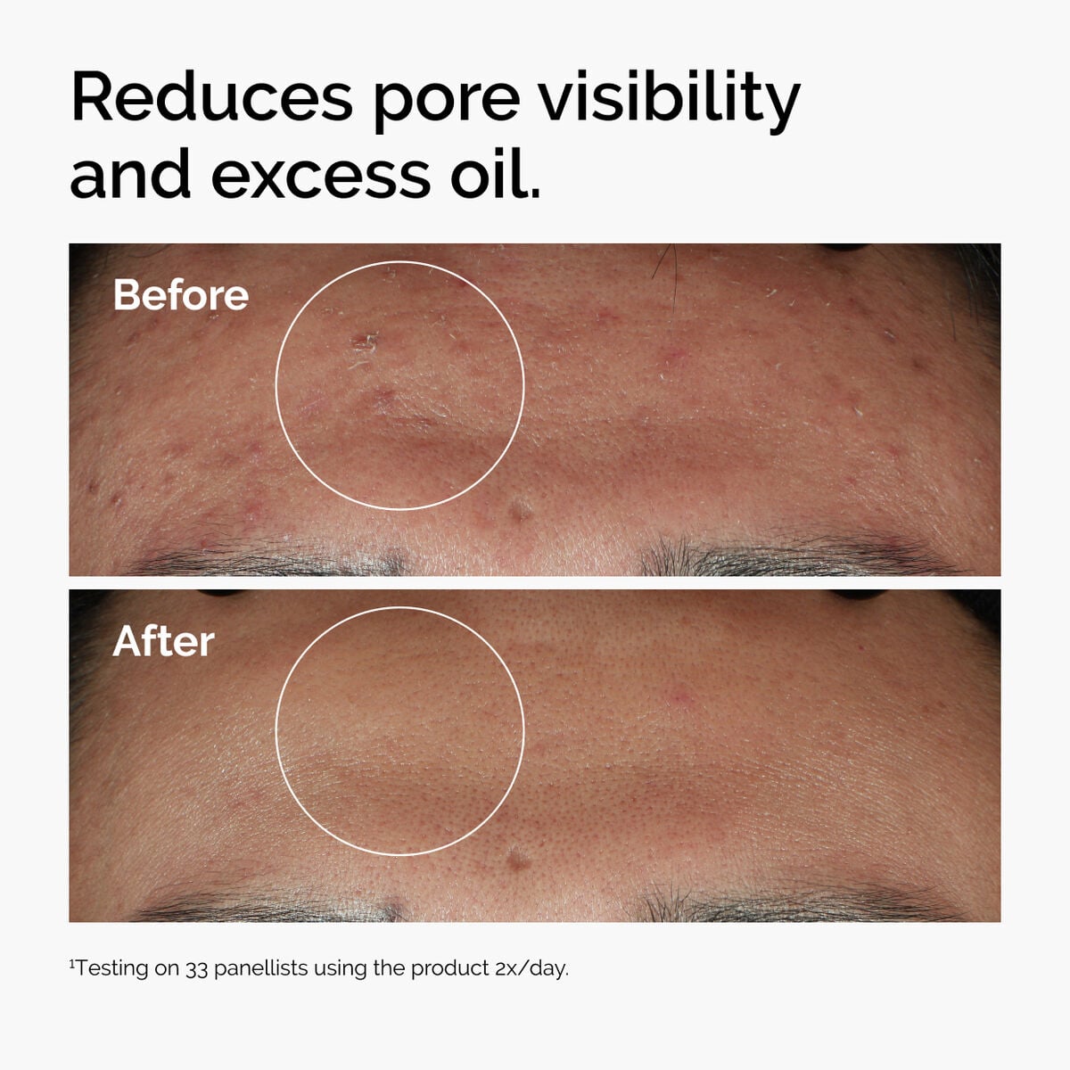 Niacinamide 10% + Zinc 1% Blemish-Prone Skin Serum