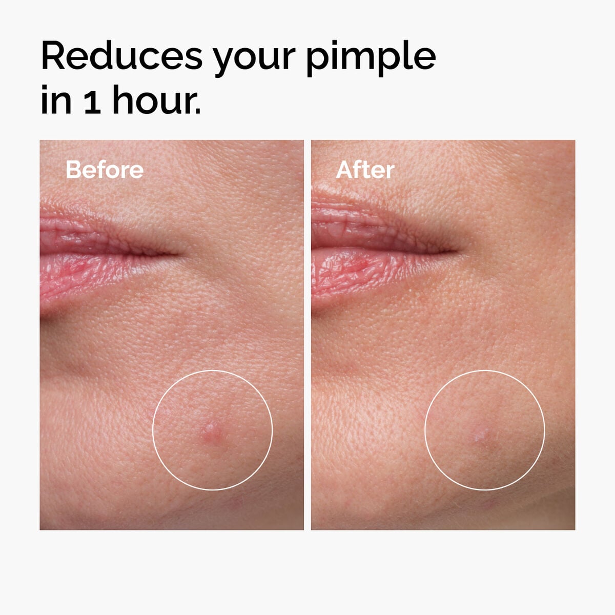 Sulfur 10% Powder-to-Cream Acne Concentrate
