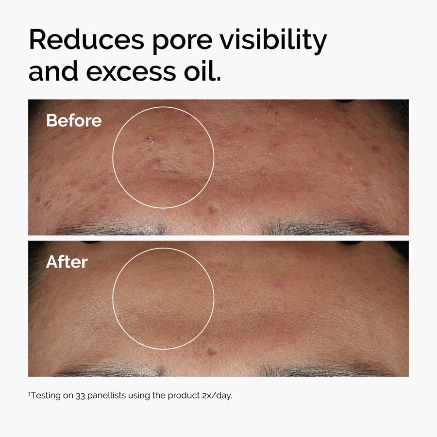 Niacinamide 10% + Zinc 1% Blemish-Prone Skin Serum
